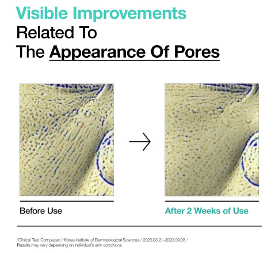 Before and after comparison of pore appearance after using Anua's BHA 2% Gentle Exfoliating Toner