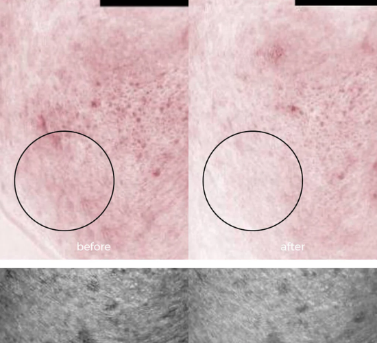 Before and after comparison of skin texture with a magnified view showing improvement after consistently using WNP hyaluric acid serum for 30 days.