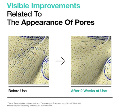 Before and after comparison of pore appearance after using Anua's BHA 2% Gentle Exfoliating Toner