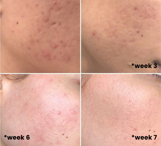 7 week results of using Dr. Althea 345 cream