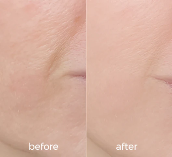Before and after comparison of skin texture after using WNP hyaluronic serum for 30 days