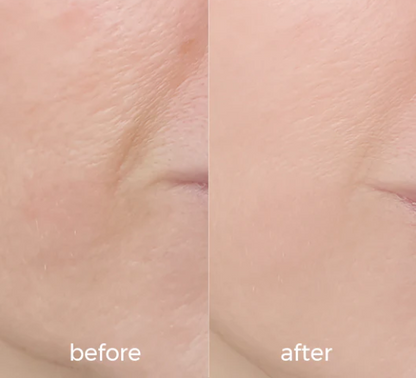 Before and after comparison of skin texture after using WNP hyaluronic serum for 30 days