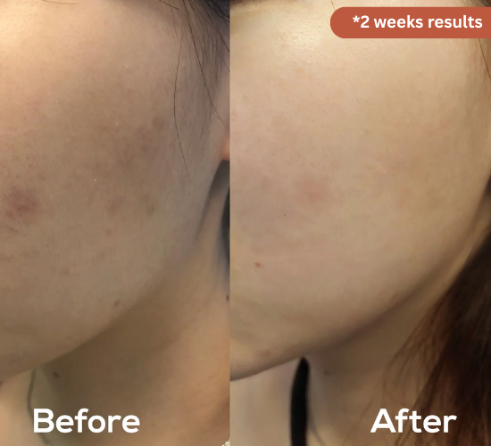 Before and after comparison of skin treatment after using axis- y dark spot glow serum