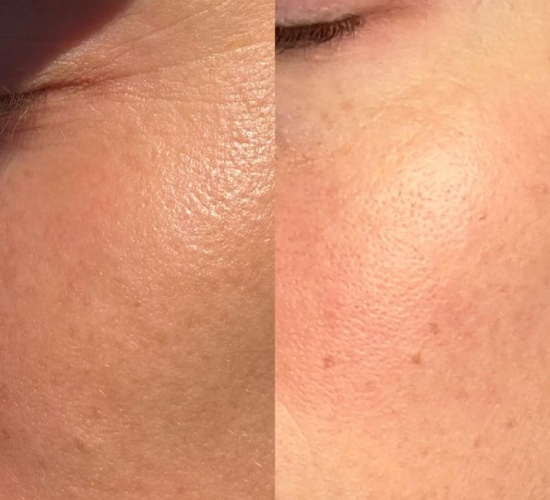 The Ordinary Glycolic Acid 7% Toner results: smoother skin, reduced dark spots, and brighter complexion.